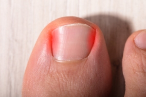 Type 1 Diabetes and Its Link to Ingrown Toenails