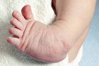 Various Types of Clubfoot