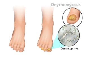 Managing Fungal Toenail Infections