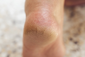 Cracked Heels Information